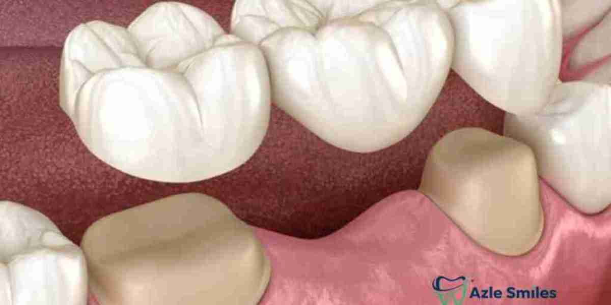 Why More People Are Choosing Dental Crowns For A Confident Smile