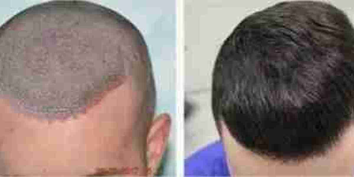 The Impact of Hair Transplantation on Self-Confidence: Stories from Dubai