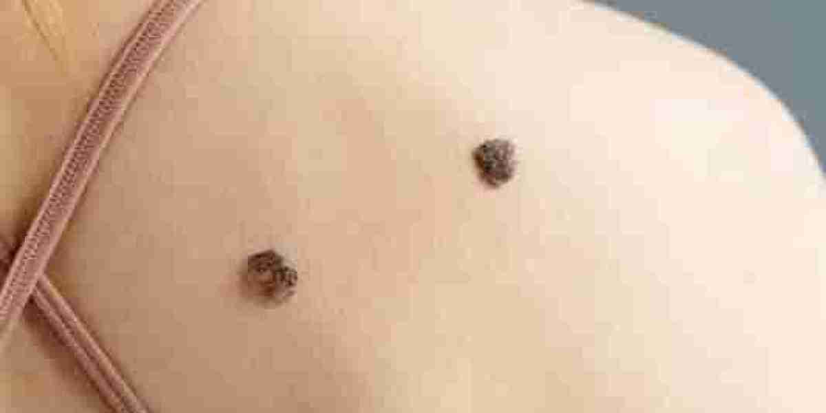 "From Creams to Procedures: A Comprehensive Guide to Skin Tag Removal Treatments"