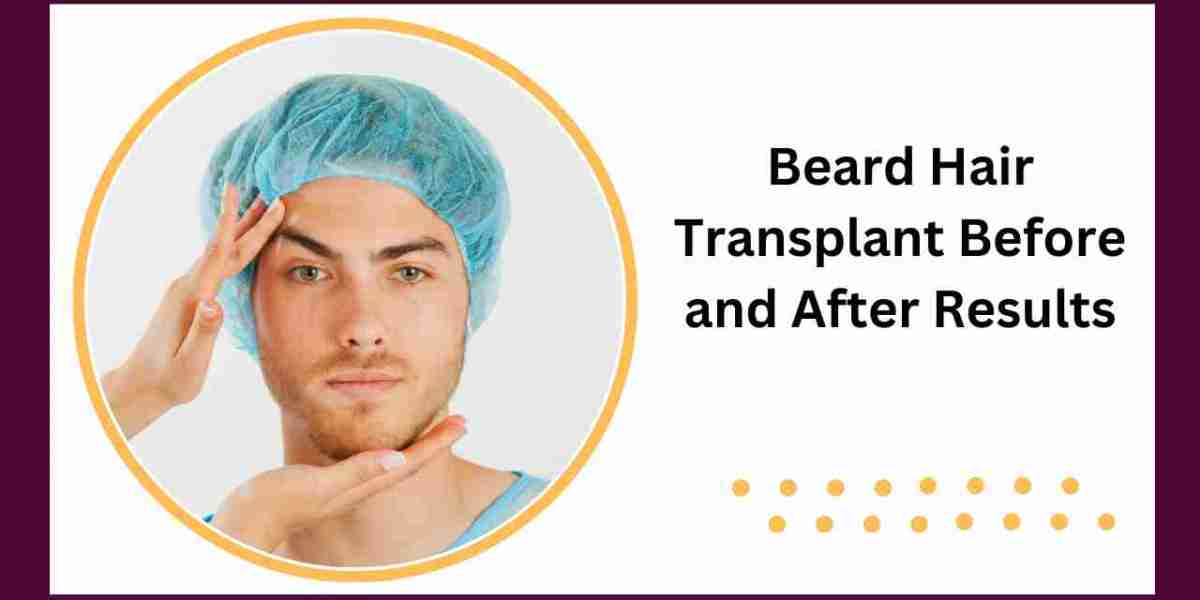 Beard Hair Transplant Before and After Results