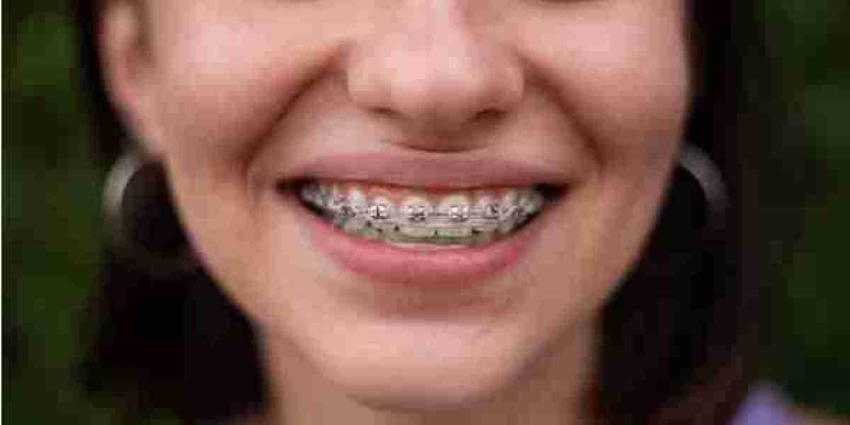 The Classic Choice: Why Traditional Braces Are Still Popular in Columbu