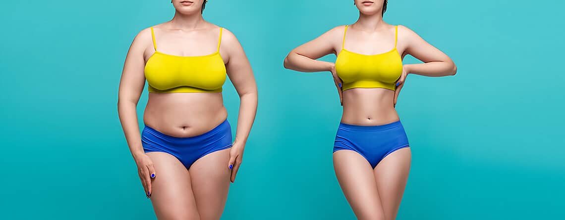 Liposuction or Tummy Tuck: Making the Right Choice