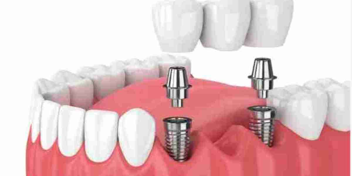 affordable dental implants abu dhabi