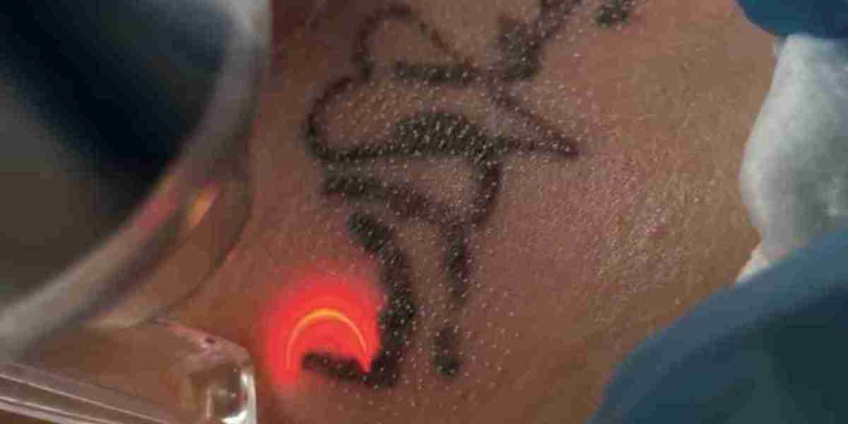 How to Choose the Right Laser Tattoo Removal Clinic in Dubai