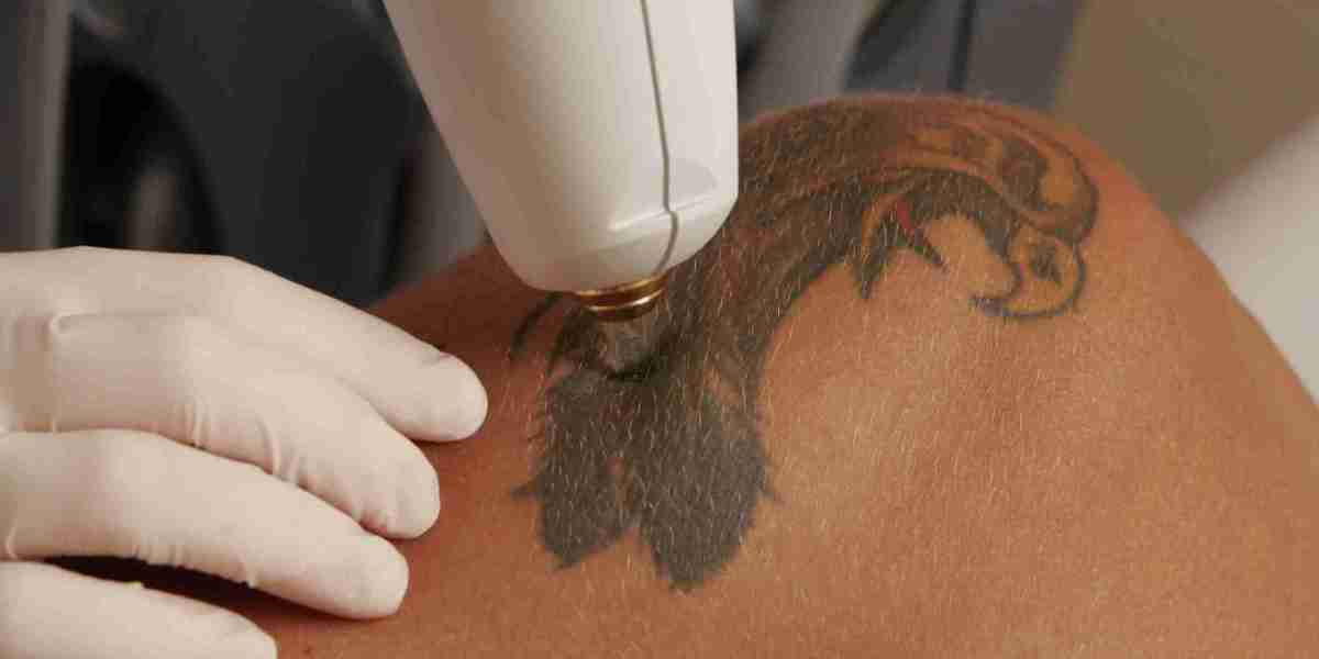 How to Choose the Right Laser Tattoo Removal Clinic in Dubai