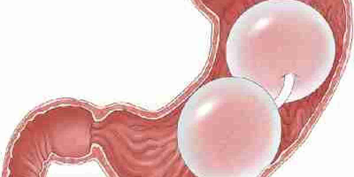 Gastric Balloon Placement: Benefits and Considerations