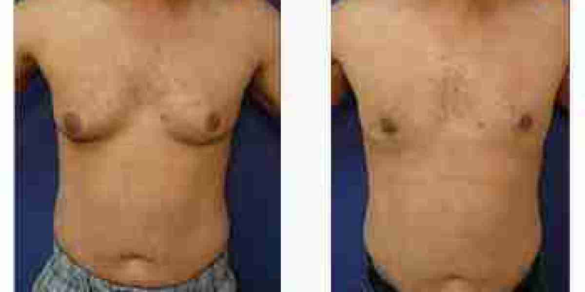 Lifestyle Changes to Manage Gynecomastia