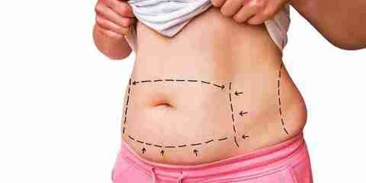 Innovations in Liposuction Surgery: The Latest Techniques in Dubai