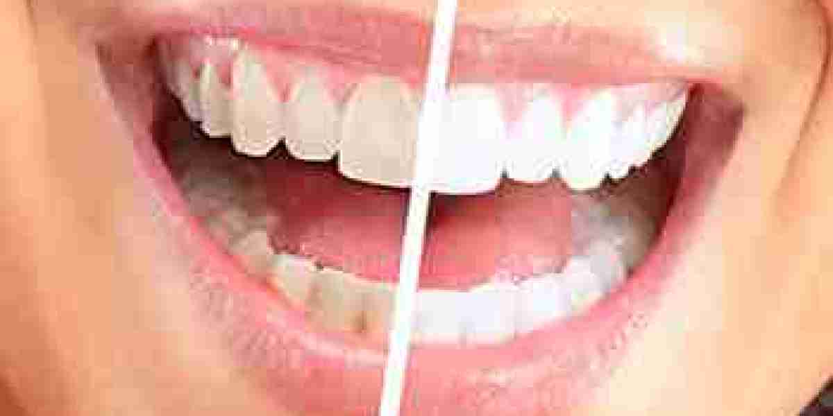 Enhance Your Smile: Teeth Whitening Options in Dubai