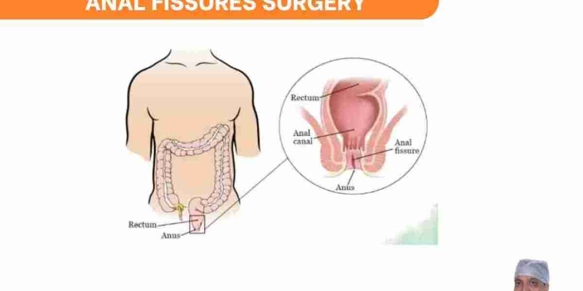 Healing Anal Fissures: From Diagnosis to Treatment