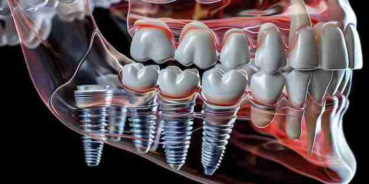 Everything You Need to Know About All-on-Four Dental Implants