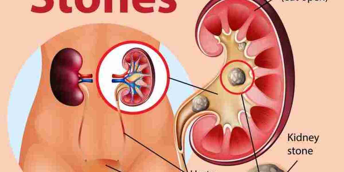 Kidney Stone Treatment in Pune with Dr Abhijit Gokhale