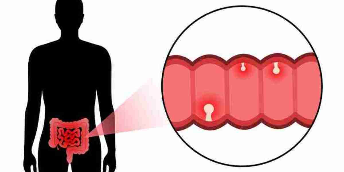 Different Types of Colon Polyps and Their Cancer Risk