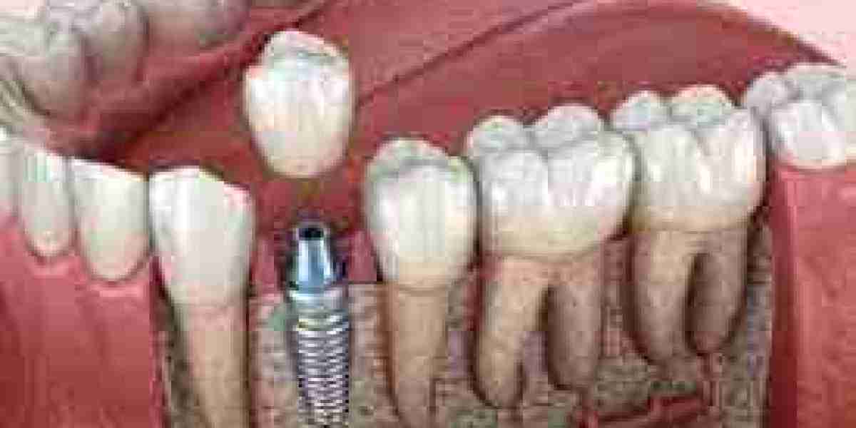 How to Choose Single Tooth Implants in Dubai