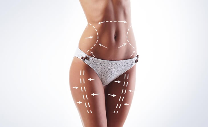 Liposuction Surgery in Delhi - Fat Removal Surgery Cost in India