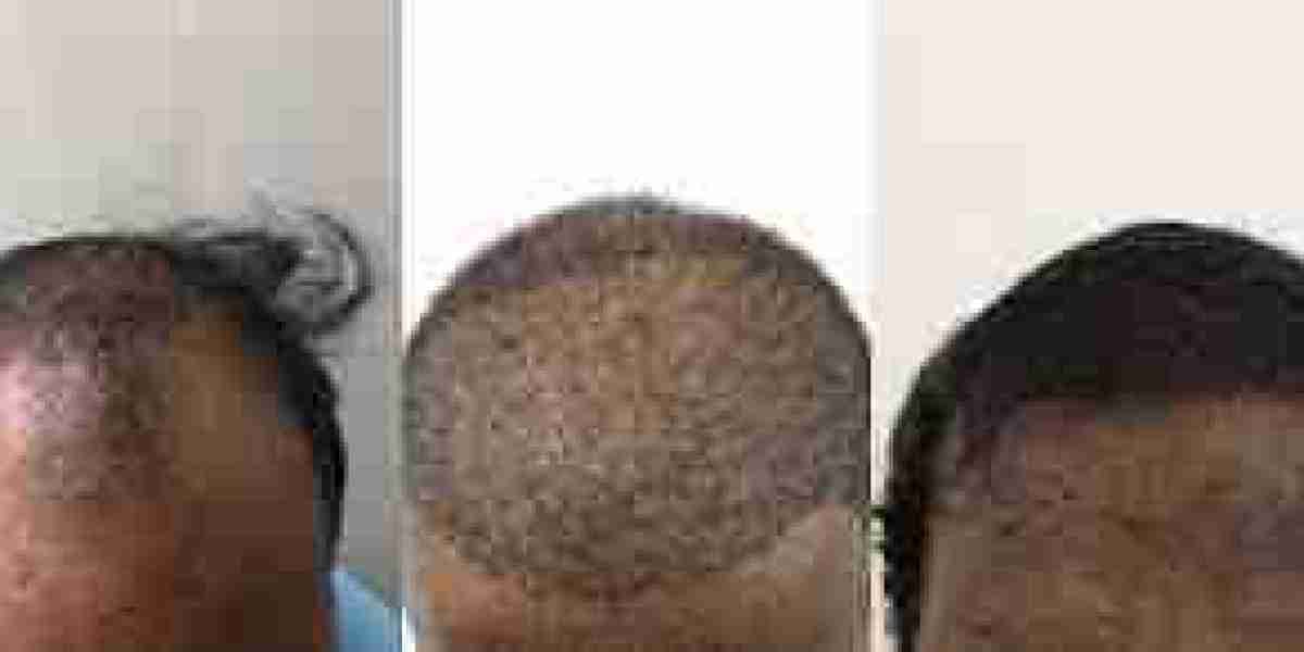 Hair Transplant in Chennai: The Path to a Fuller Head of Hair