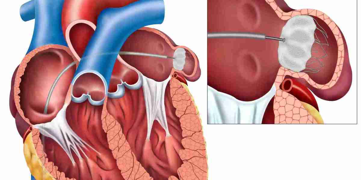 Reducing Stroke Risk: Causes and Prevention of Left Atrial Appendage Closure