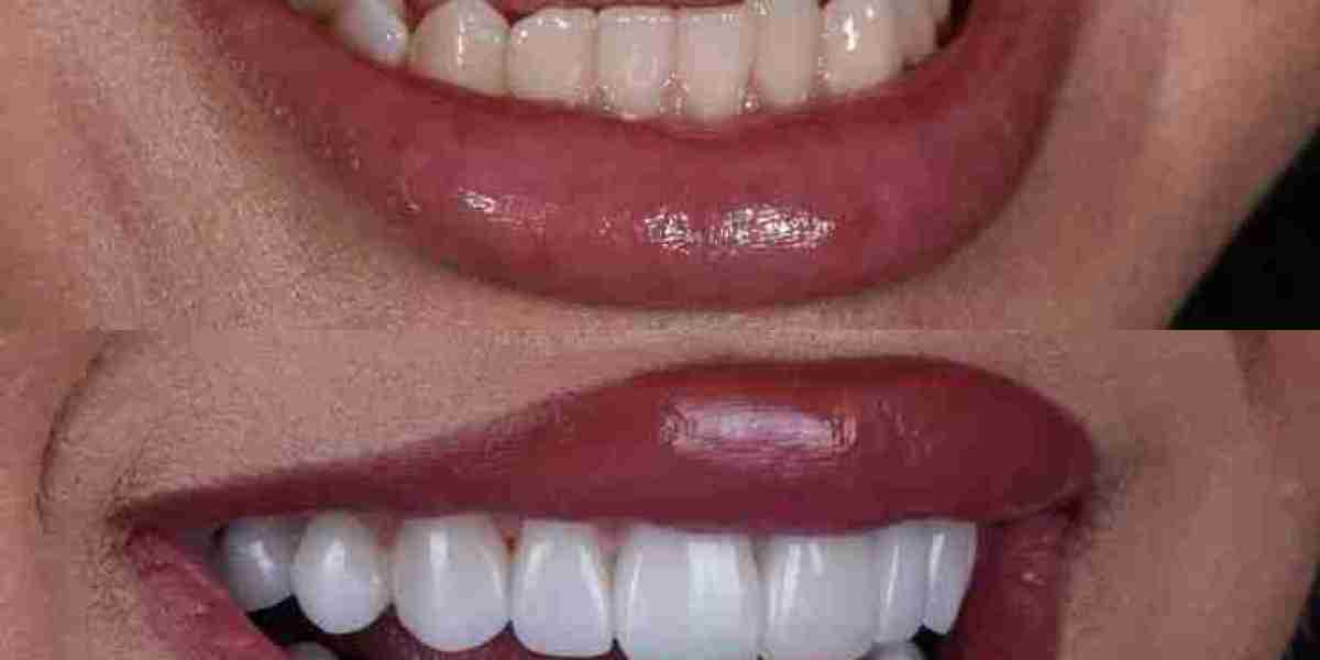 White Fillings: A Modern Approach to Tooth Restoration