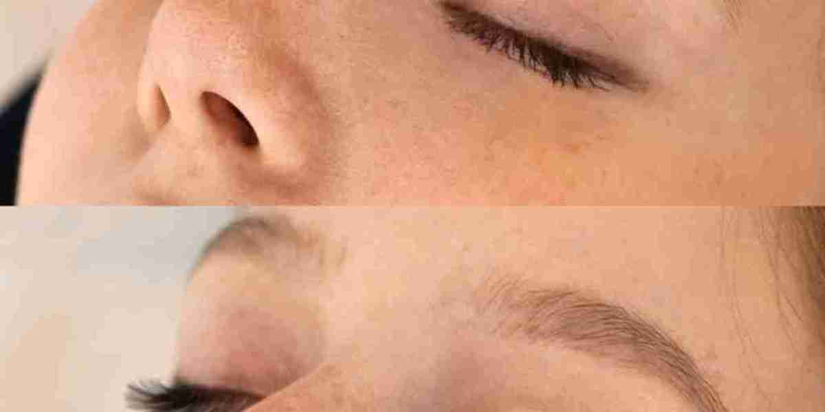 Botox Near Me in Chino: 20 Units of Botox Before and After