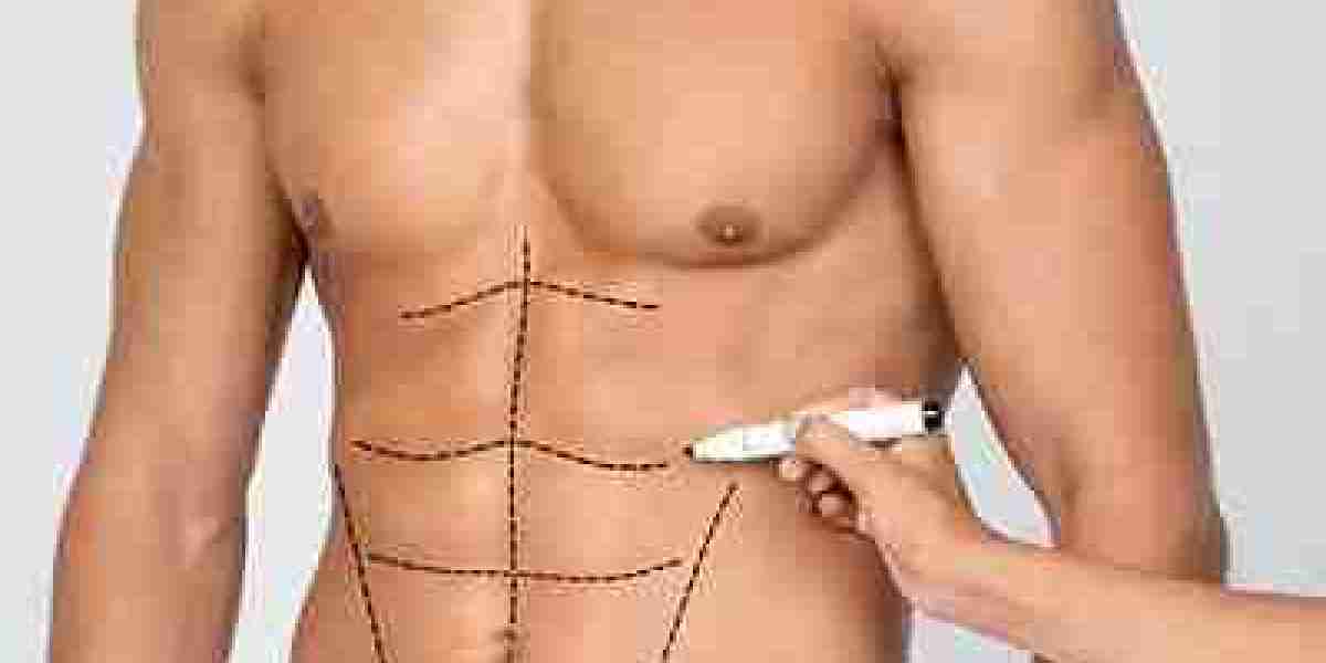 Liposuction vs. Traditional Weight Loss: Which is Right for You?