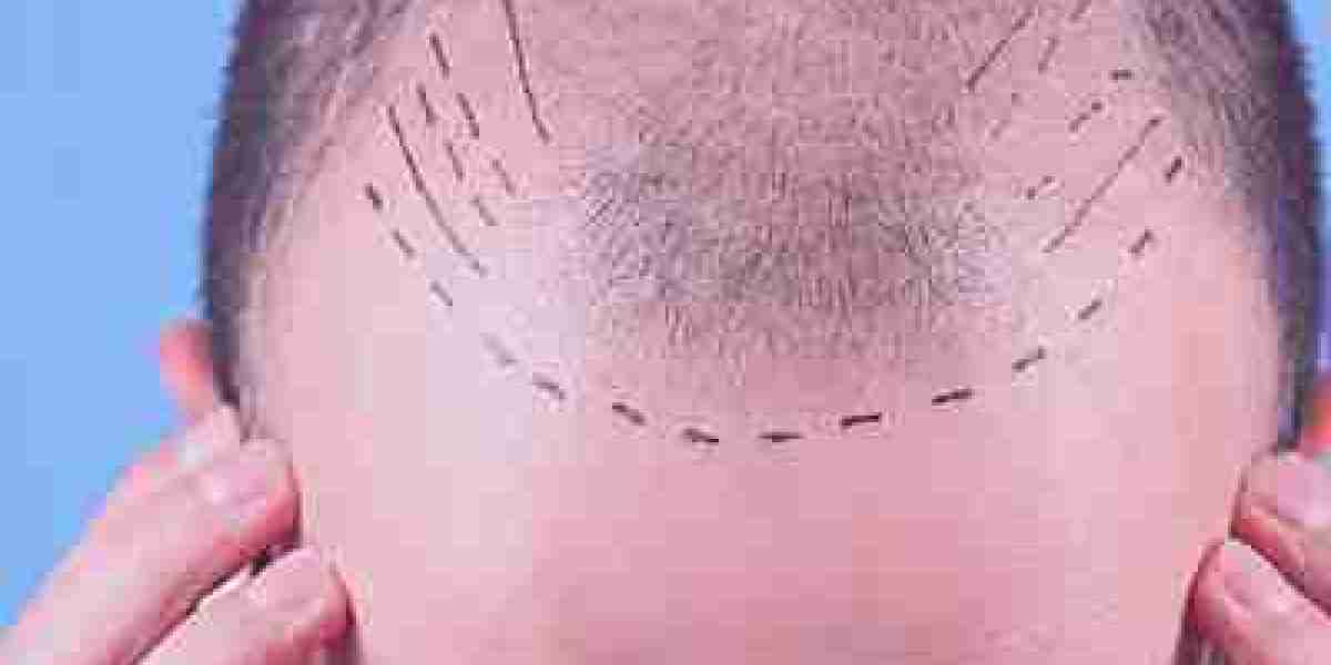 Your Guide to a Successful Hair Transplant Journey in Dubai