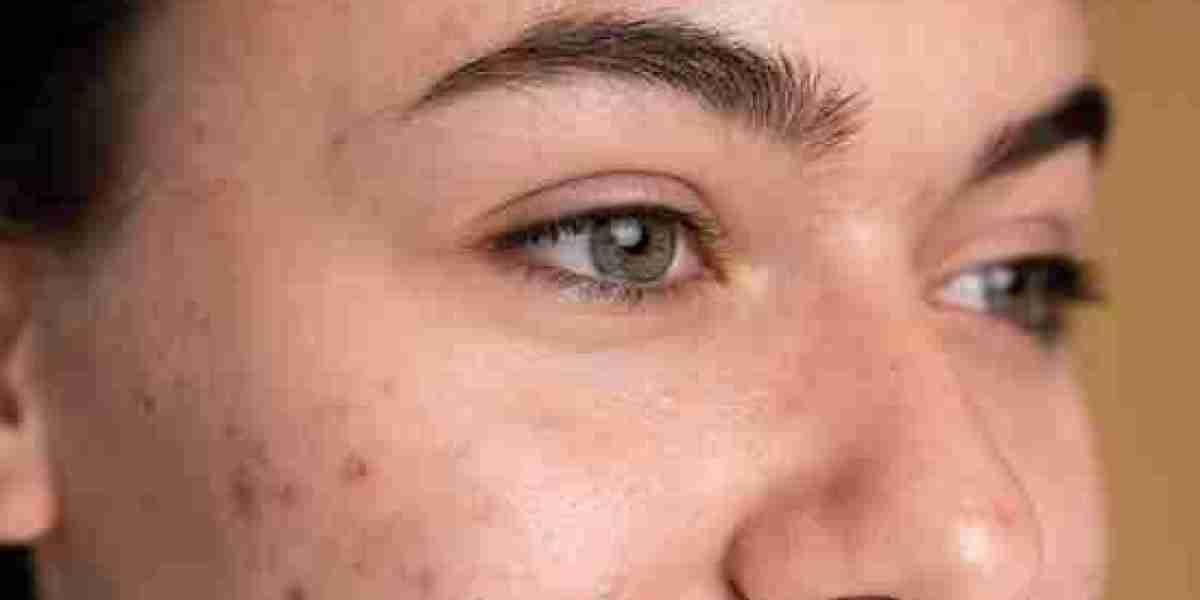 Effective Hyperpigmentation Treatment Options in Manchester