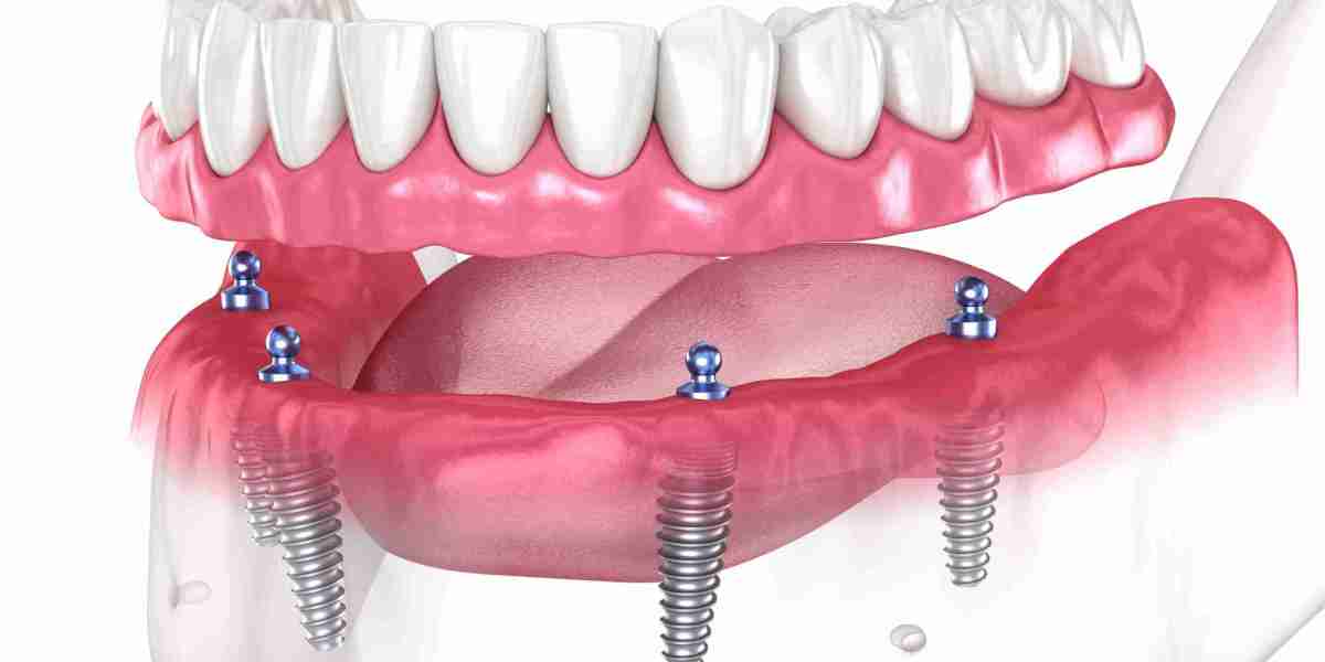 Can You Get Dental Implants If You Have Gum Disease?