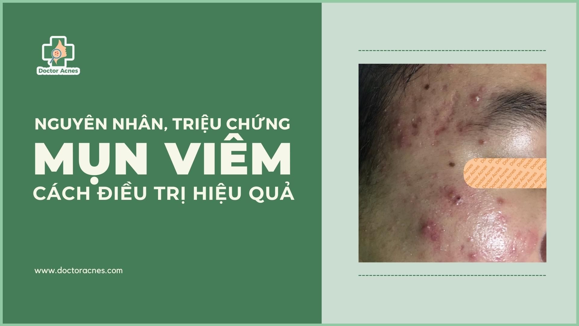 Mụn viêm là gì? Cách điều trị và phòng ngừa hiệu quả