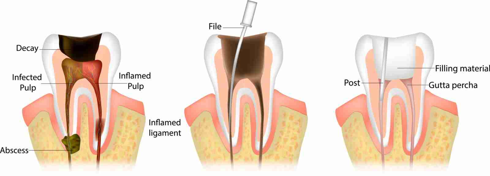 Root Canal Treatment near me