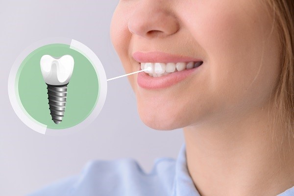 The Evolution of Dental Implant Technology: Innovations and Advances