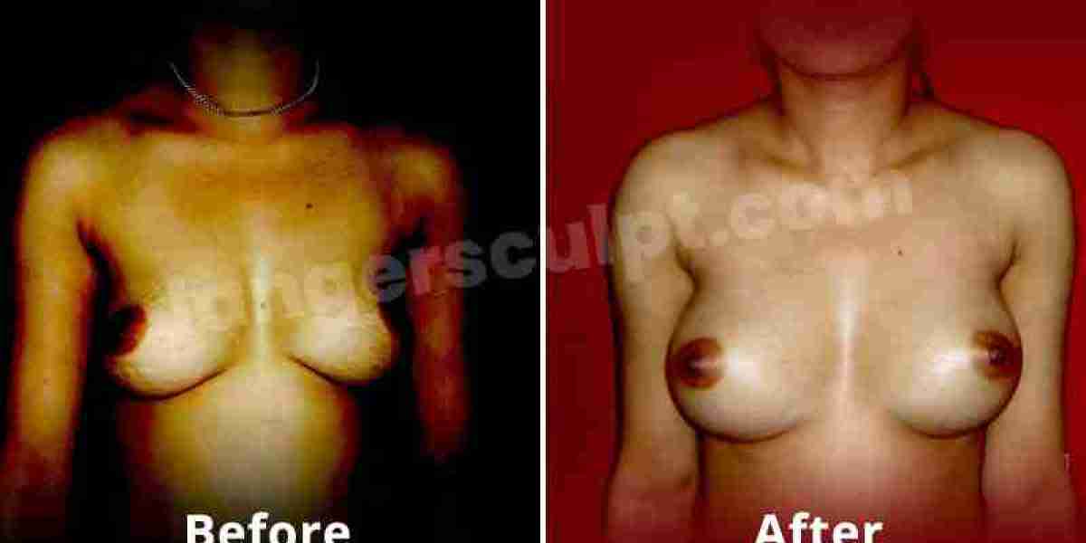 Breast enlargement in Delhi