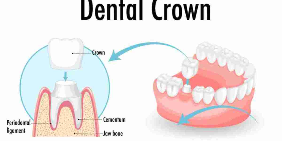 Smile Makeovers Made Easy with Dental Crowns