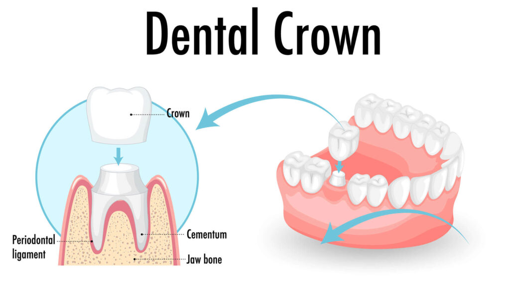 Dental Crown Solutions To Restore Your Smile | All Cosmetic Dental