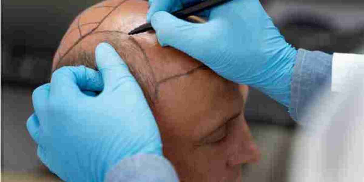 What to Expect During Your Hair Transplant Consultation in London