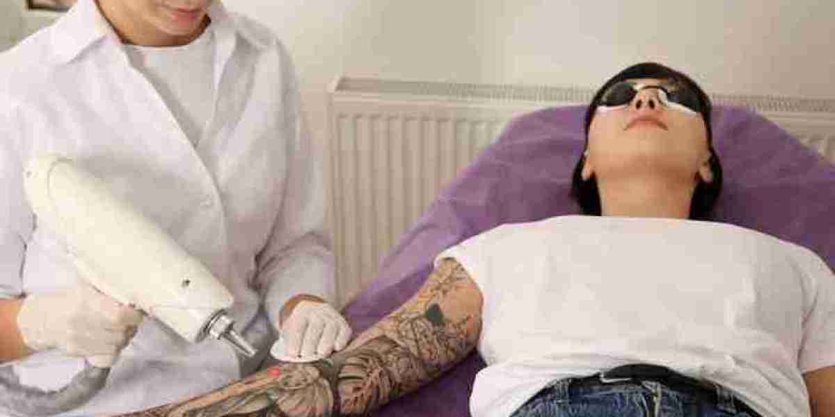 What to Expect During Your Laser Tattoo Removal Session