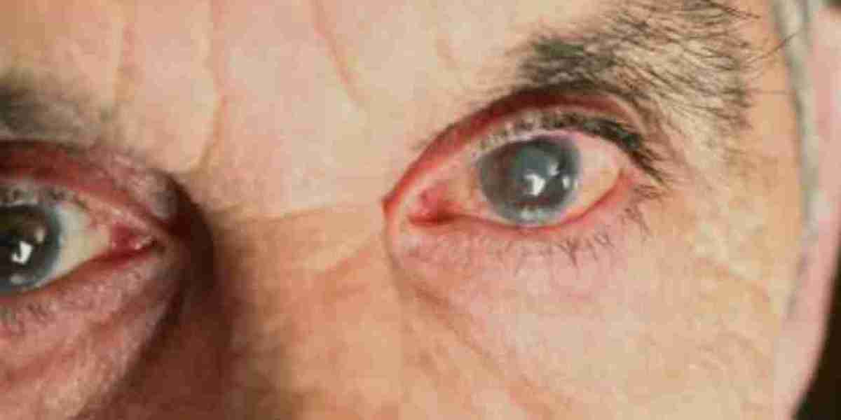 Global Age-Related Macular Degeneration Market Share, Size, Trends, Growth & Forecast | 2024 - 2032