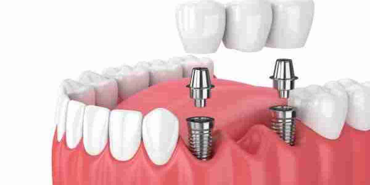 Chi phí làm răng implant: Những yếu tố cần lưu ý khi quyết định cấy ghép răng