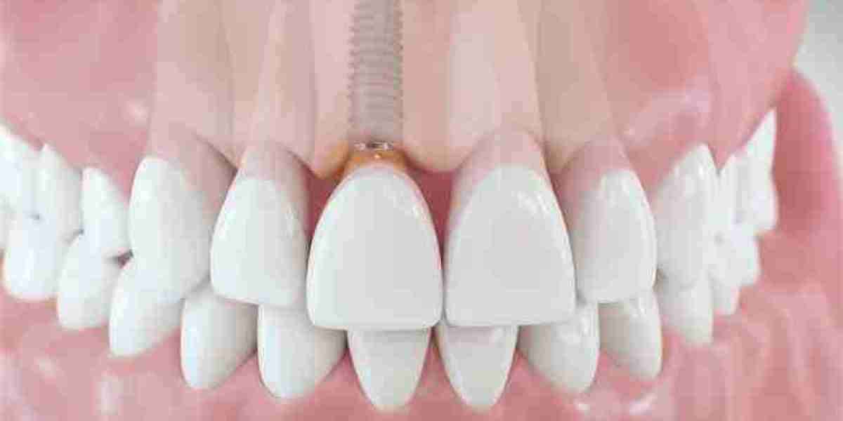 Top Clinics for Dental Implants in Riyadh: Where to Go