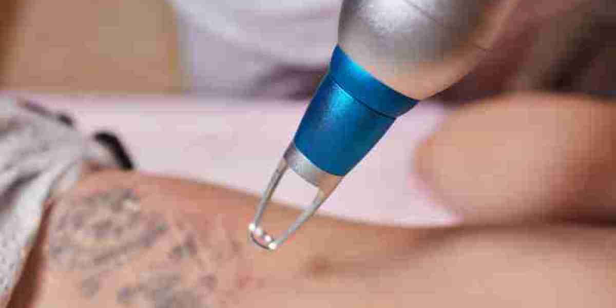 Laser Tattoo Removal vs. Other Methods: Pros and Cons