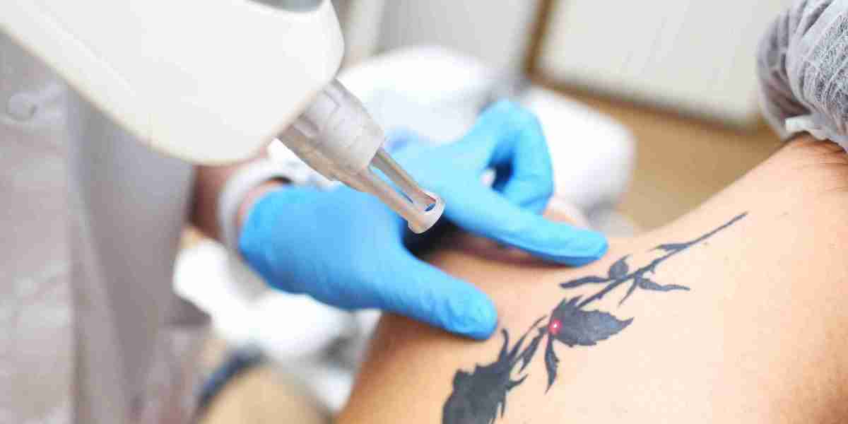 How Many Sessions Does Laser Tattoo Removal Take in Dubai?