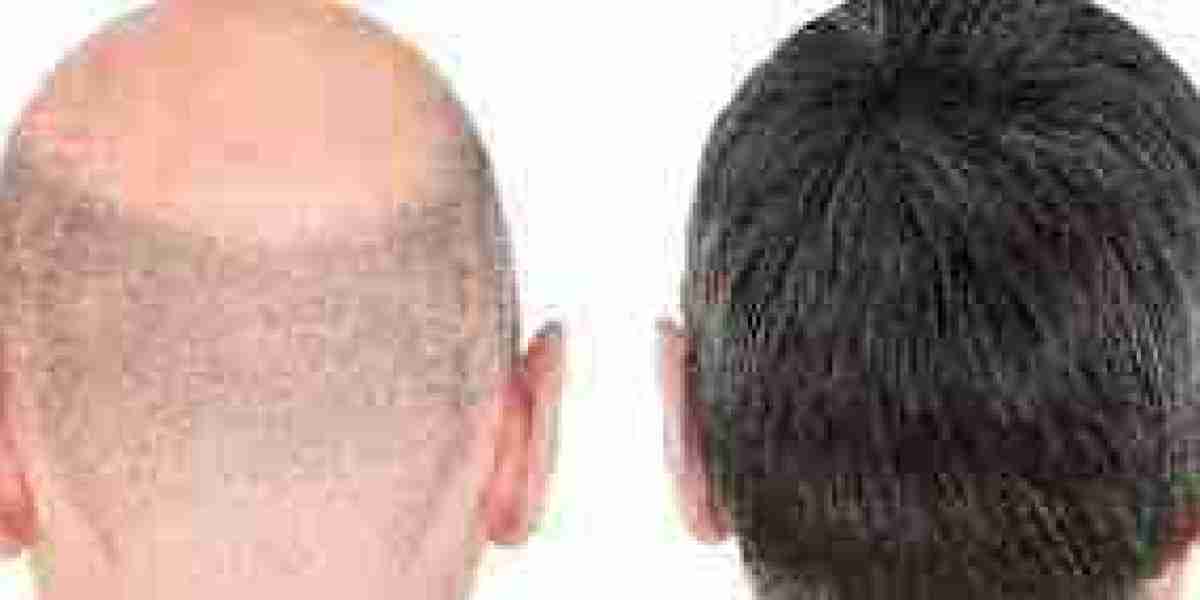 How Long Do the Results of Hair Transplants Last?