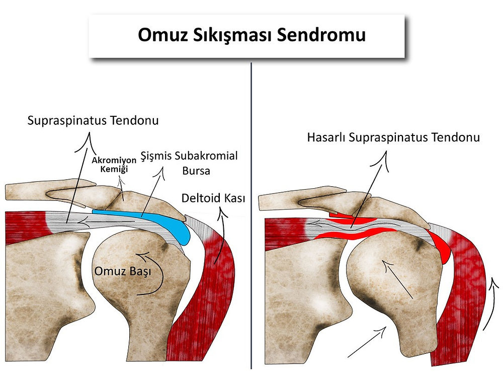 Omuz Sıkışma Sendromu Nedir? | İmpingement Sendromu Belirtileri?