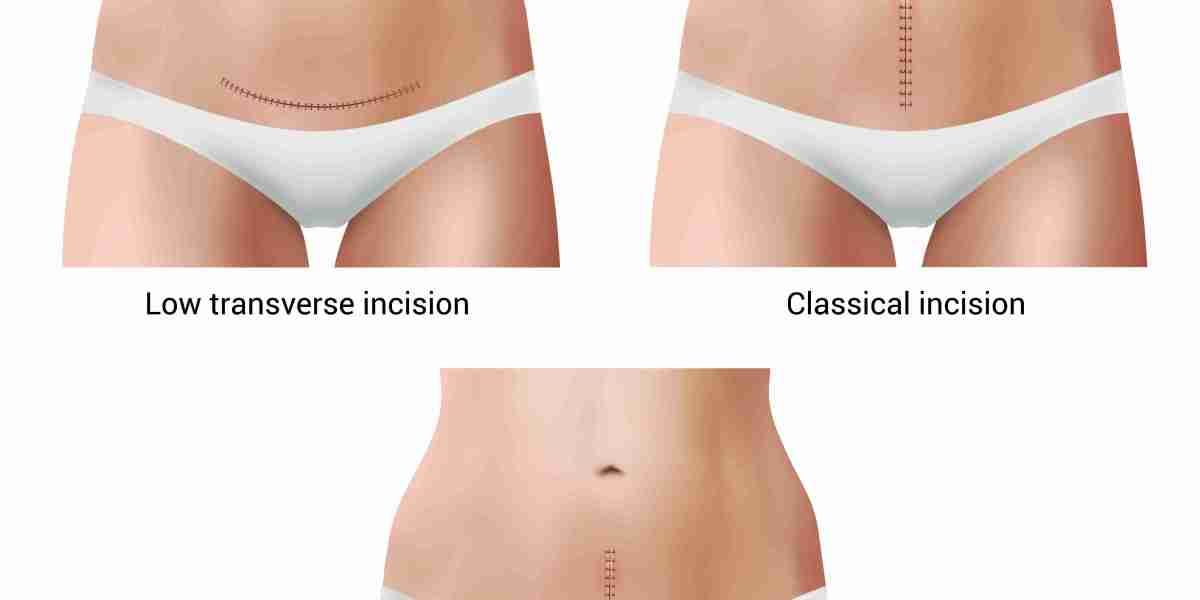 Get a Flatter, Firmer Stomach with the Best Tummy Tuck in New York