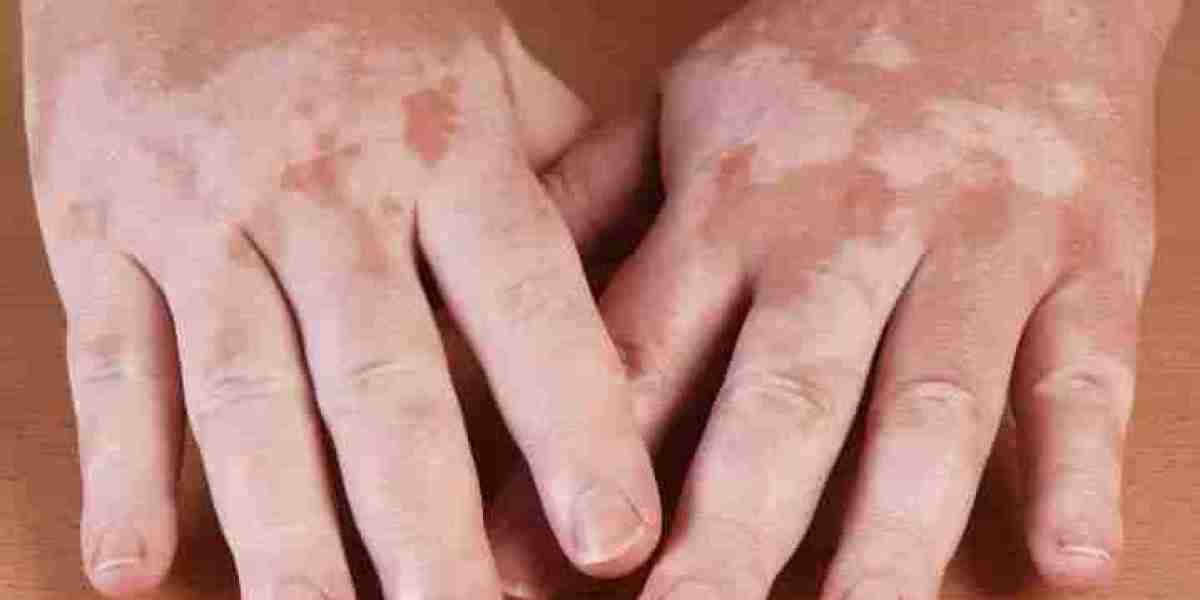 Does Vitiligo Spread to Other Body Parts? Here's What You Should Know