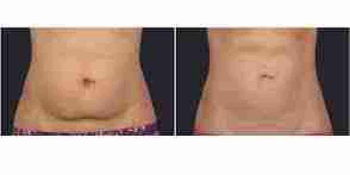 Non-invasive Fat Reduction  Market - Massive Growth opportunity ahead