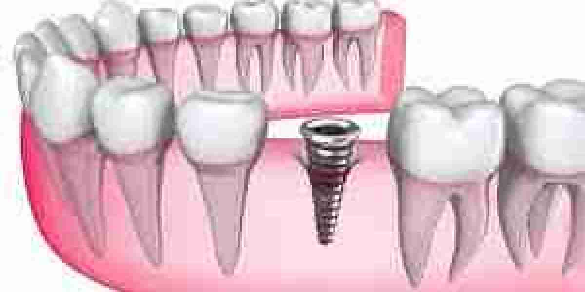 Gắn implant có đau không? Giải đáp từ chuyên gia nha khoa hàng đầu tại Nha khoa Sing