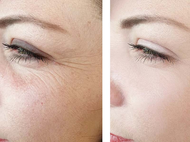 Anti Wrinkle Injections Clonmel: Reveal Youthful Radiance with Care