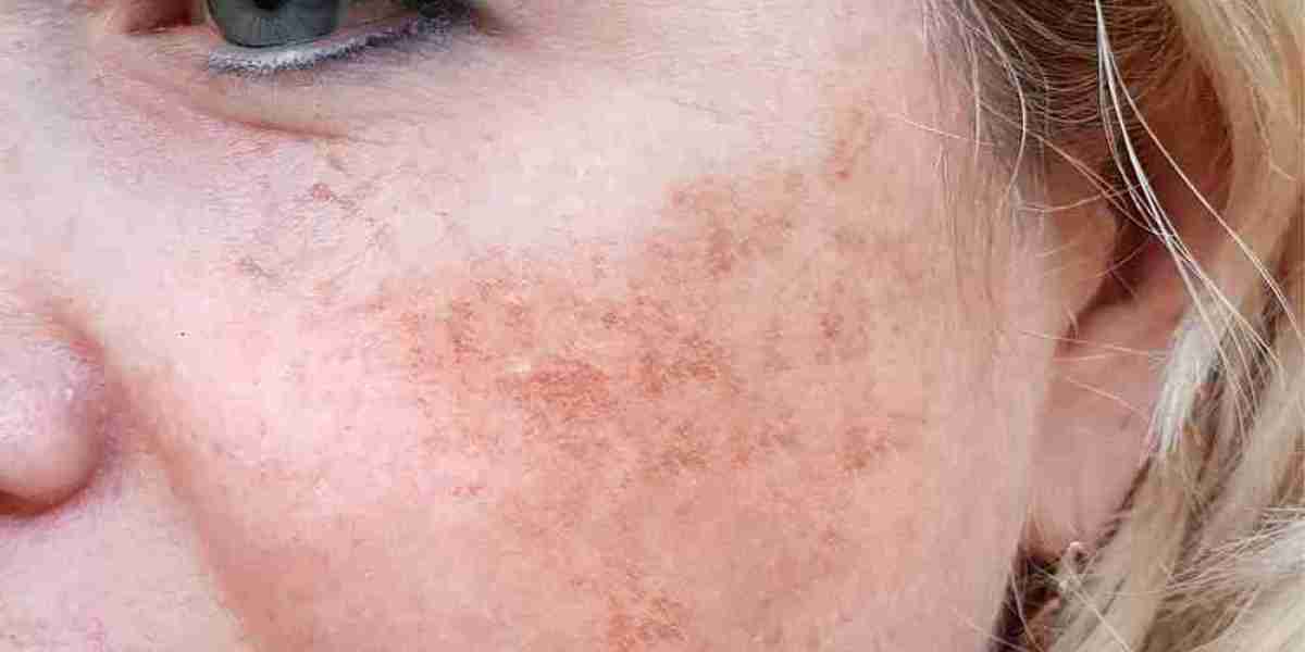 Permanent Solutions for Melasma in Islamabad: Is It Possible?