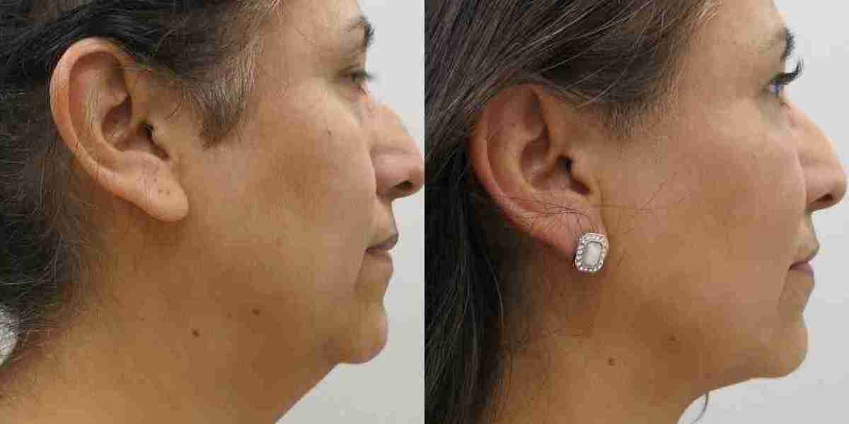 Common Concerns About Neck Liposuction