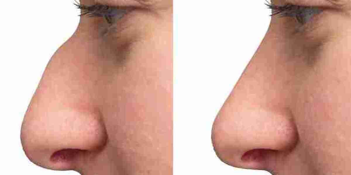 Risks and Complications of Rhinoplasty: What You Need to Know